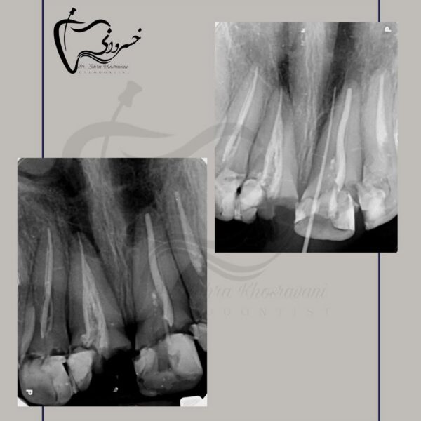 درمان مجدد دندان های قدامی