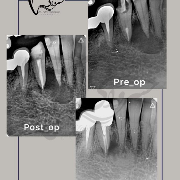 درمان مجدد دندان کانین مندیبل