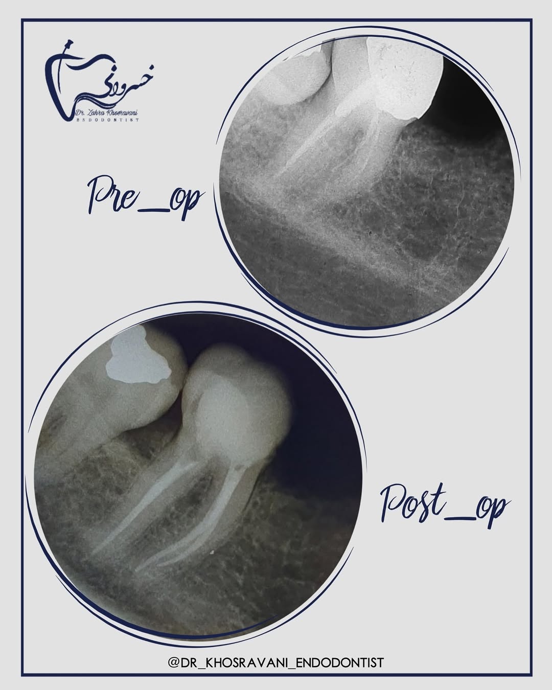 درمان ریشه مجدد مولر دوم مندیبل