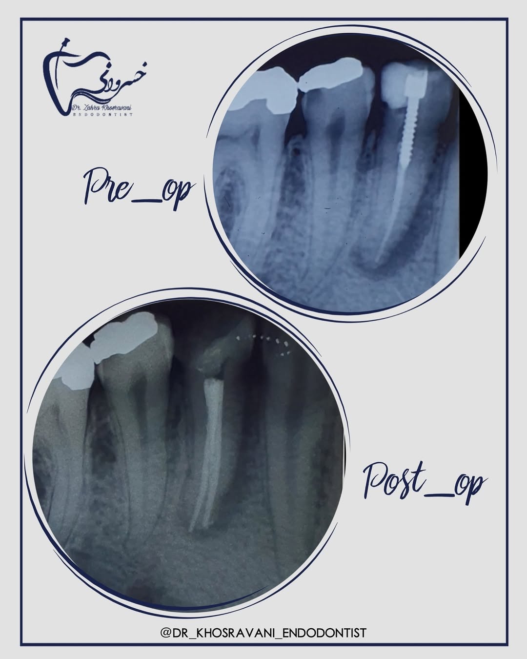 درمان مجدد پرمولر مندیبل دو کانال