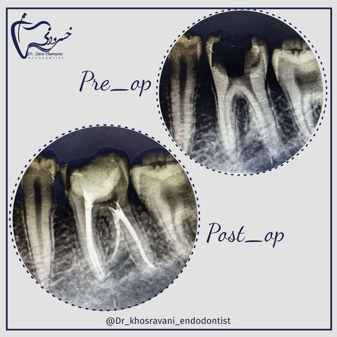 درمان مولر های اول مندیبل