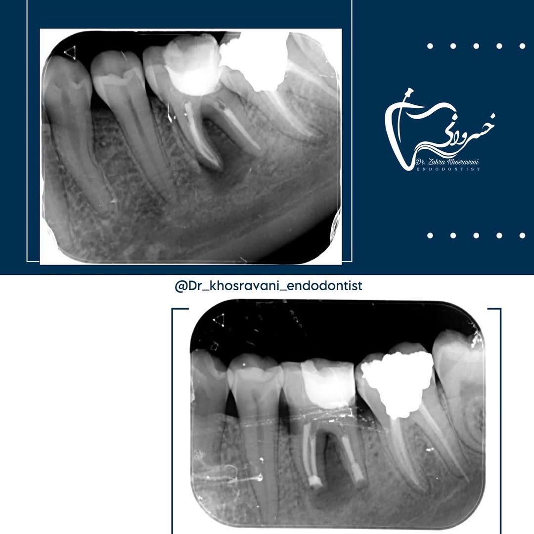 درمان مولر های اول مندیبل با ریشه رادیکس