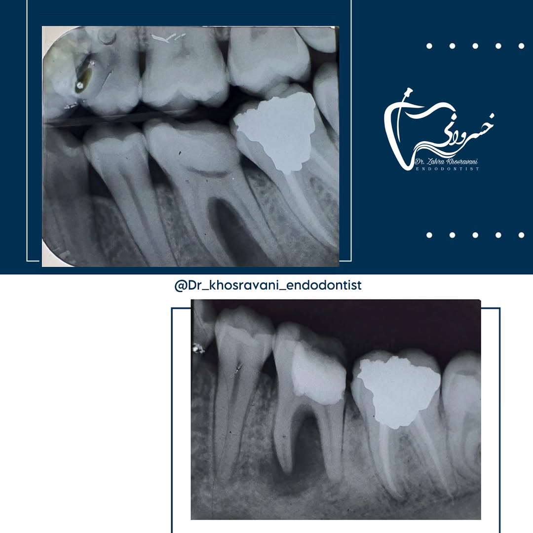 درمان مولر های اول مندیبل با ریشه رادیکس