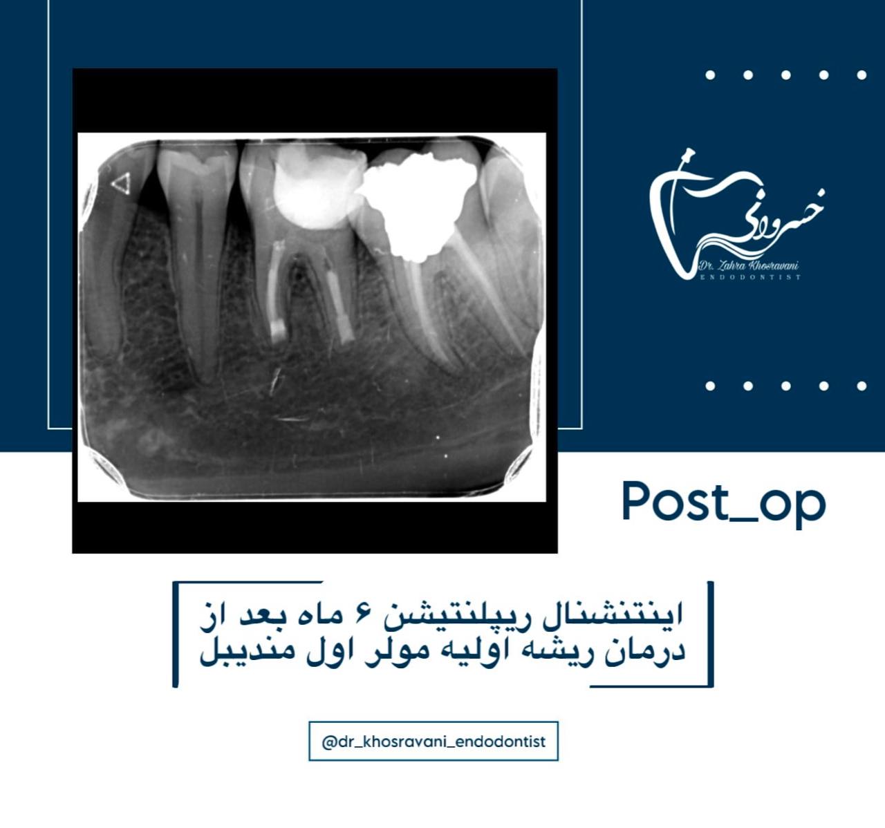درمان ریشه اولیه مولر اول مندیبل